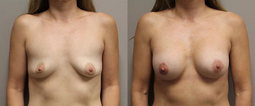 augmentation lift before and after photos by kryger institute of plastic surgery in thousand oaks ca