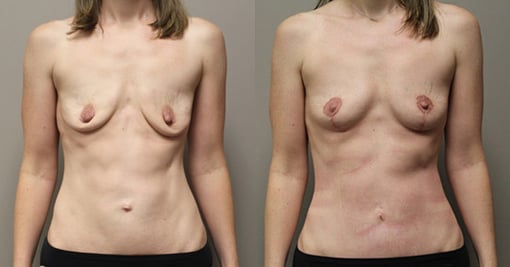 augmentation lift before and after photos by kryger institute of plastic surgery in thousand oaks ca