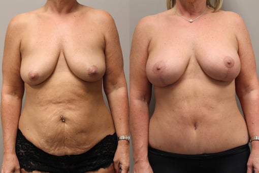 augmentation lift before and after photos by kryger institute of plastic surgery in thousand oaks ca