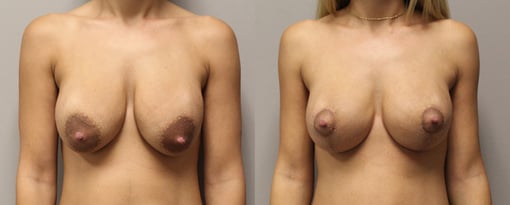 augmentation lift before and after photos by kryger institute of plastic surgery in thousand oaks ca