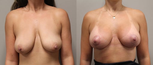 augmentation lift before and after photos by kryger institute of plastic surgery in thousand oaks ca