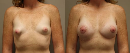 augmentation lift before and after photos by kryger institute of plastic surgery in thousand oaks ca