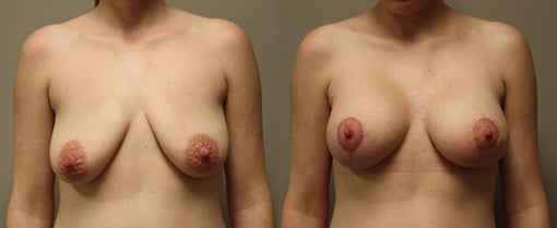 augmentation lift before and after photos by kryger institute of plastic surgery in thousand oaks ca