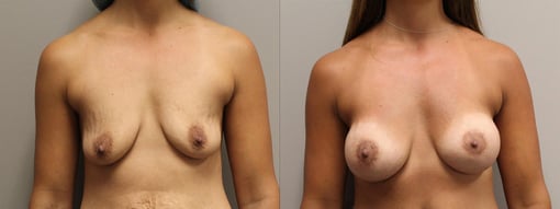 augmentation lift before and after photos by kryger institute of plastic surgery in thousand oaks ca