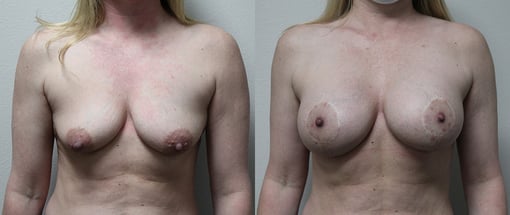 augmentation lift before and after photos by kryger institute of plastic surgery in thousand oaks ca