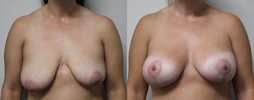 augmentation lift before and after photos by kryger institute of plastic surgery in thousand oaks ca