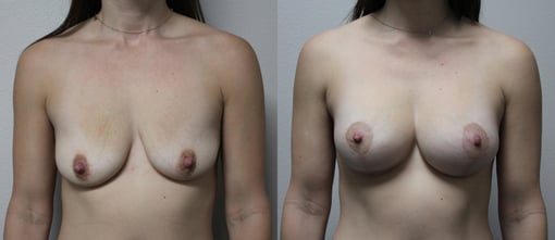 augmentation lift before and after photos by kryger institute of plastic surgery in thousand oaks ca