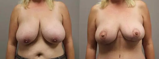 diep flap reconstruction before and after photos by kryger institute of plastic surgery in thousand oaks ca