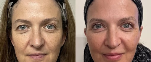 blepharoplasty fat grafting before and after photos by kryger institute of plastic surgery