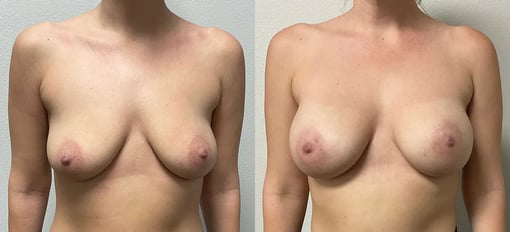 front view breast augmentation before and after photos by kryger institute of plastic surgery