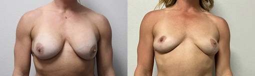 front view breast implant removal and lift before and after photos by kryger institute of plastic surgery