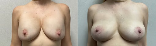 front view breast implant removal and lift before and after photos by kryger institute of plastic surgery