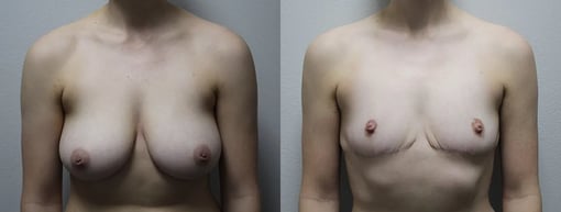 front view breast reduction before and after photos by kryger institute of plastic surgery