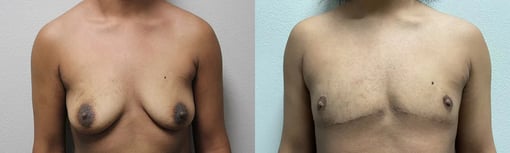 front view trans male top surgery before and after photos by kryger institute of plastic surgery