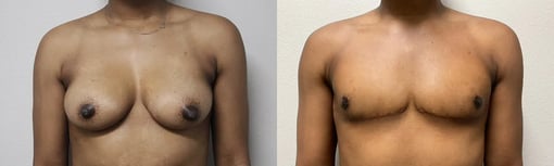 front view trans male top surgery before and after photos by kryger institute of plastic surgery
