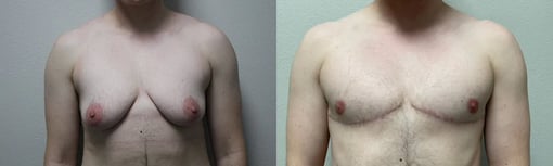 front view trans male top surgery before and after photos by kryger institute of plastic surgery
