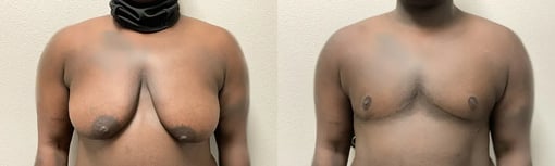 front view trans male top surgery before and after photos by kryger institute of plastic surgery
