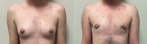 front view trans male top surgery before and after photos by kryger institute of plastic surgery