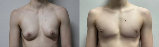 front view trans male top surgery before and after photos by kryger institute of plastic surgery