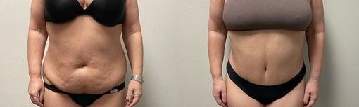 front view tummy tuck before and after photos by kryger institute of plastic surgery